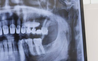Dientes desgastados: causas y soluciones