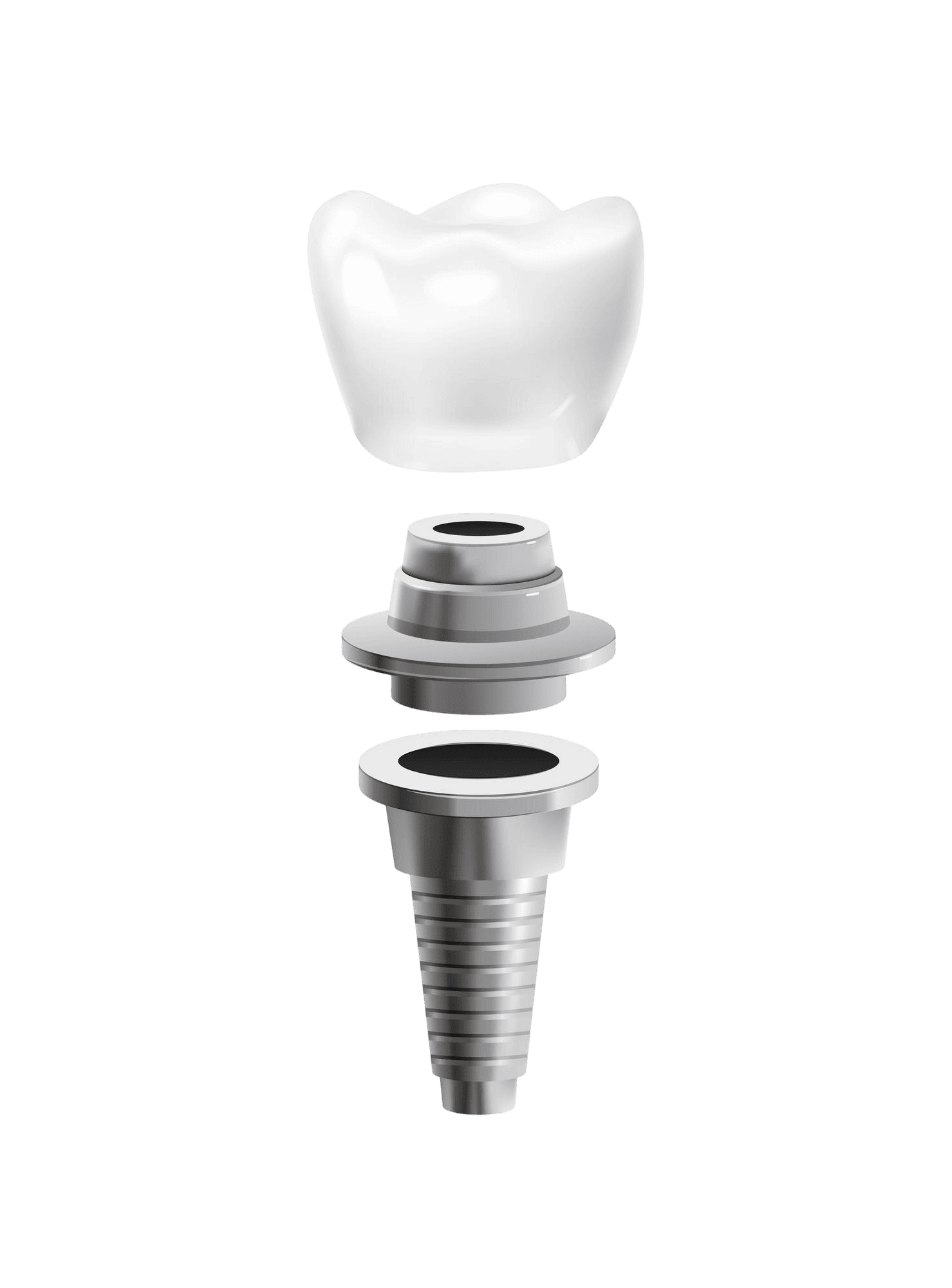 implantes dentales pamplona