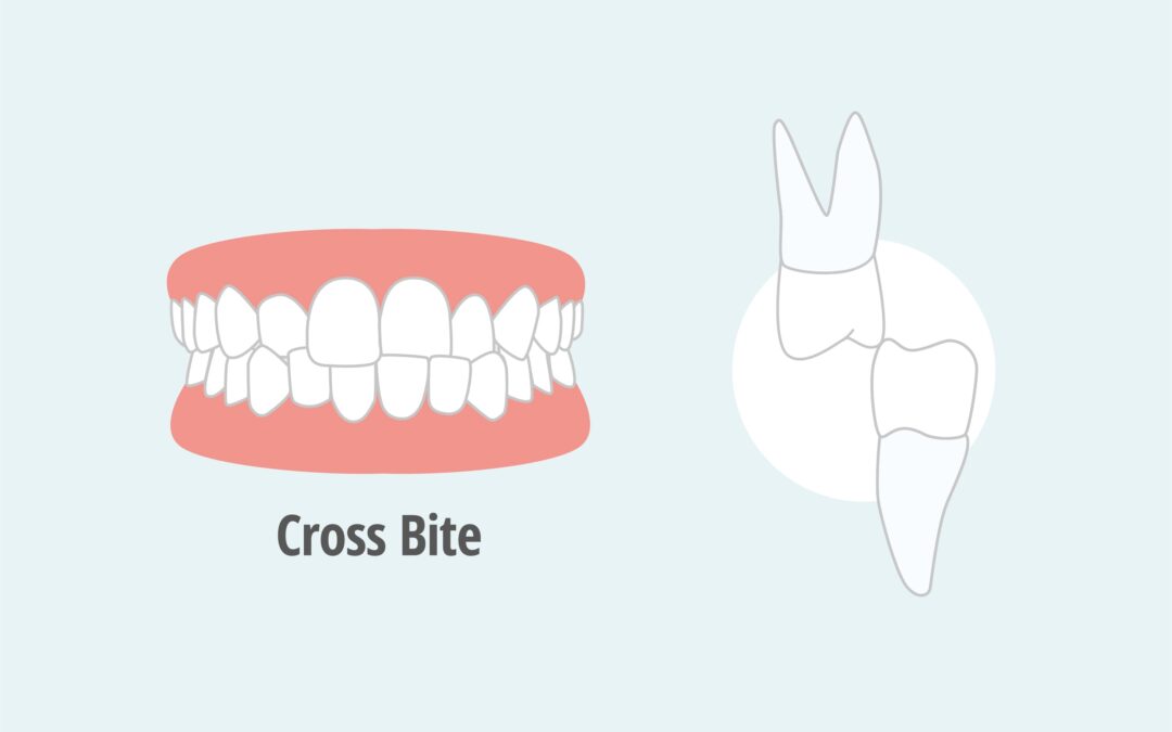 como se corrige la mordida cruzada