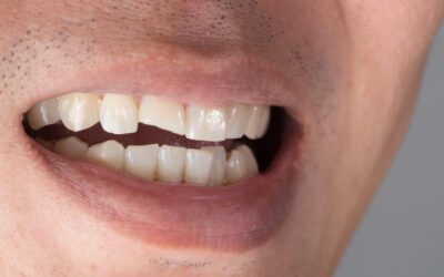 ¿Qué es una reconstrucción dental estética y cuando es necesaria?